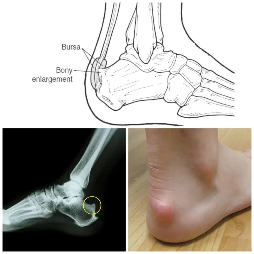 Haglund's deformity collage